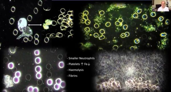 COMPUTERIZED THERMOGRAPHIC IMAGING AND LIVE BLOOD ANALYSIS POST C19 INJECTION + 5G @ 60GHZ Inhibits the uptake of oxygen into the blood