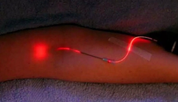 Ultraviolet Blood Irradiation Treats Cardiovascular, Infectious, Obstetric, Autoimmune + Neurological Diseases